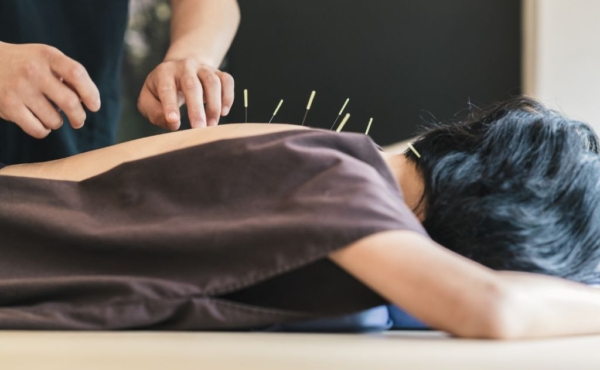 Acupuncture Adelaide